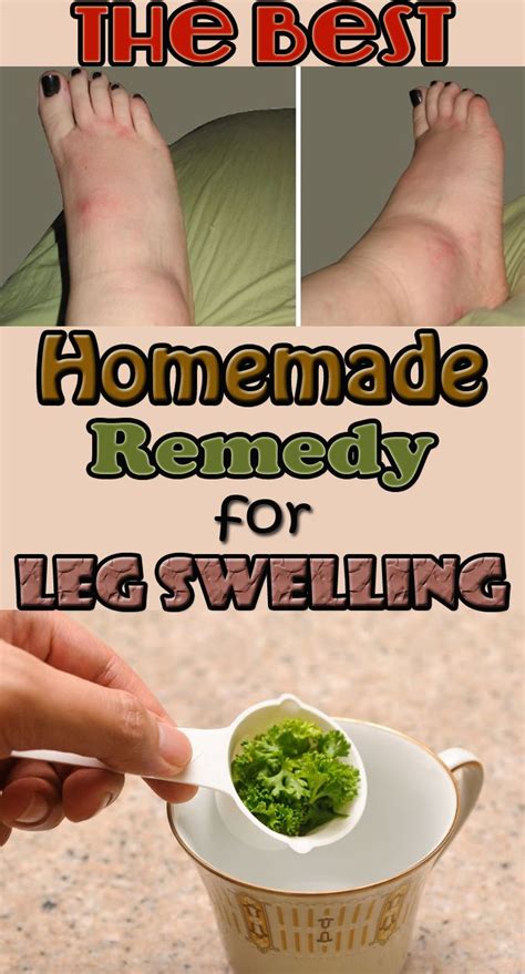 The Best Homemade Remedy For Leg Swelling Swelling