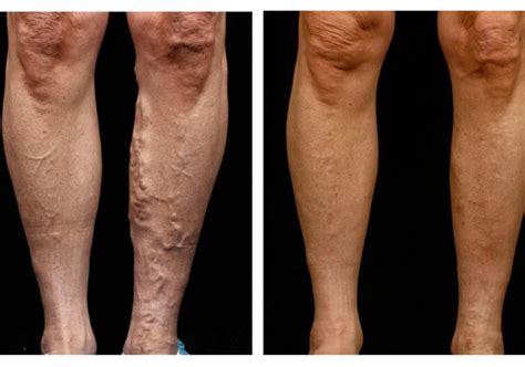 Endovenous Ablation Treatment For Varicose Veins Laser Radiofrequency