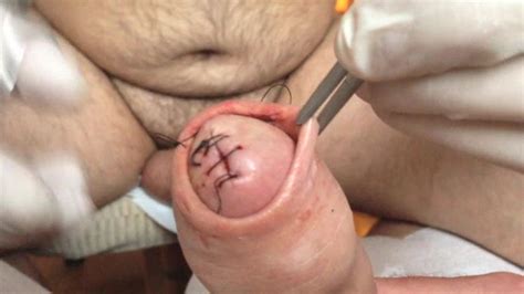 Cbt Sutures Gay Bizarre Porn At Thisvid Tube Hot Sex Picture