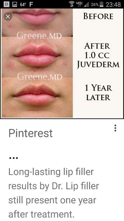 Juvederm Lip Filler 1cc Beforeafter One Year Later Photographs