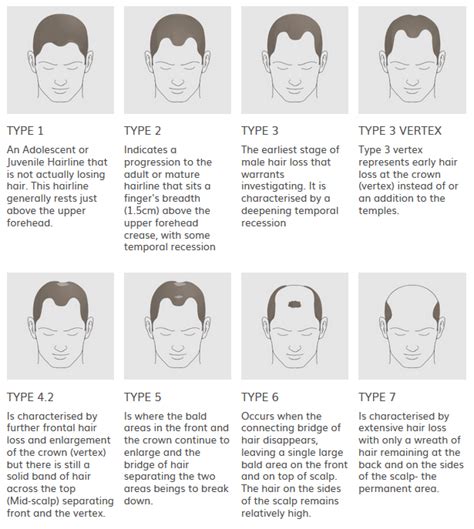 Update More Than 74 Types Of Hair Loss Male Super Hot In Eteachers