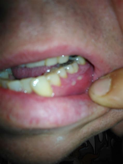 What Are These White Spots On My Gums Rdentistry
