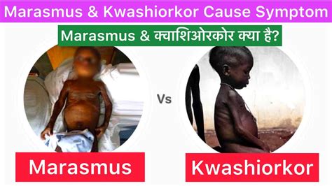 Marasmus And Kwashiorkor Cause Symptom Treatment Marasmus