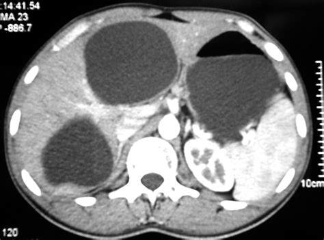 Successful Management Of Complicated Multi Organ Hydatid Cysts