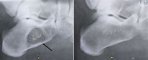 Plain Radiograph Of Both Ankles Lateral View A A Lytic Lesion Was