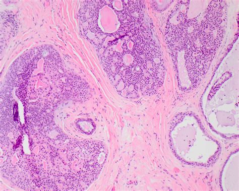 Pathology Outlines Intraductal Carcinoma