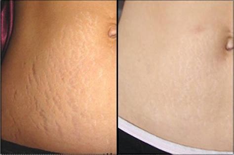 Stretch Mark Also Known As Striae Is A Kind Of Scarring That Occurs