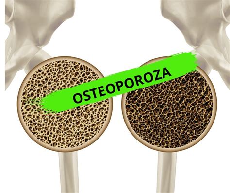 Osteoporoza Przyczyny Objawy I Leczenie Fizjo Gabinet