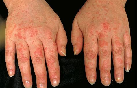 What Skin Problems Does Rheumatoid Arthritis Cause