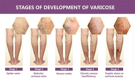 Stages Of Vein Disease—what Stage Am I Florida Lakes Vein Center
