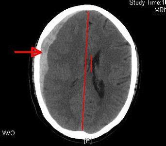 Neurosurgery Basics Subdural Hematoma Radiology Medical Babes