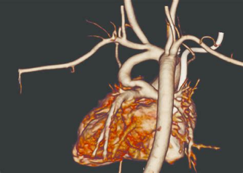 Angiotomografia De Coração E Grandes Vasos Em Caso De Atresia Pulmonar