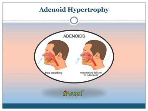 Adenoids In Children