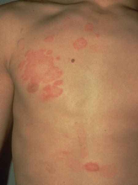 Fungal Infections Of The Skin Dermatologist In Helena Ar Jessica