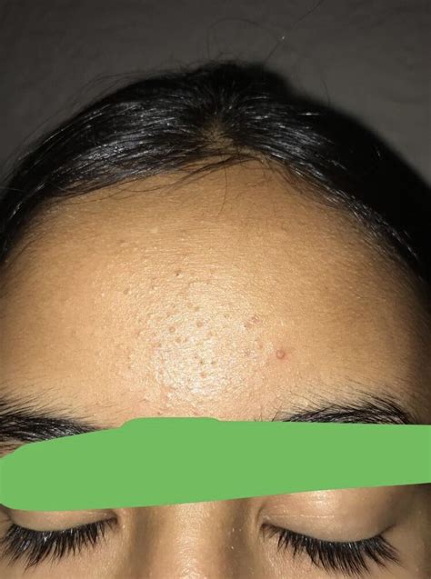Tiny Bumps On Forehead General Acne Discussion Acne Org Forum