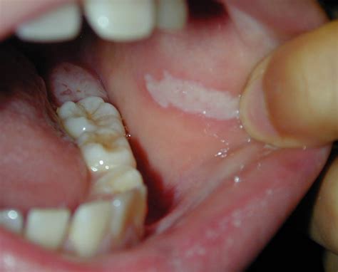 rakovina ústní slizniční tváře patro guma onkologie ústní
