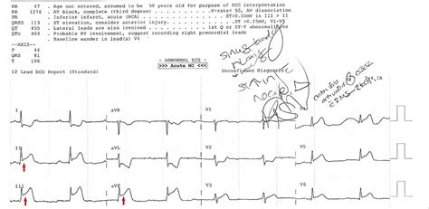 Cureus St Elevation Myocardial Infarction And Complete Heart Block In