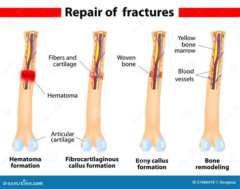 Fracture Healing Stages