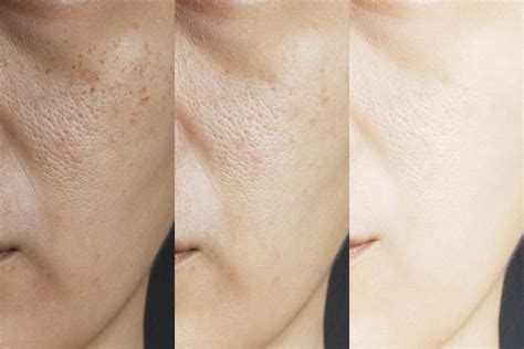Melasma Causes Prevention And Treatment Options In Singapore