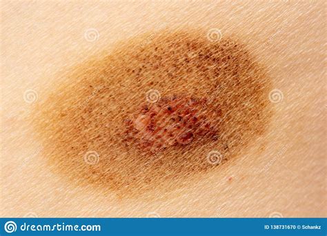 Not All Round Rashes Are Ringworm A Differential Diagnosis Of Zohal