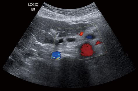 Pancreatic Cyst Ultrasound