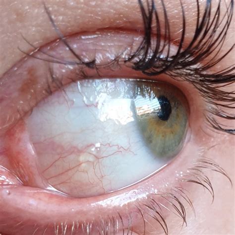 Clear Bubble On Eyeball Renew Physical Therapy