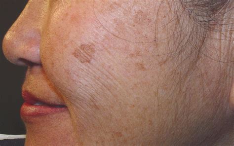 Age Spots Singhania Skin Clinic