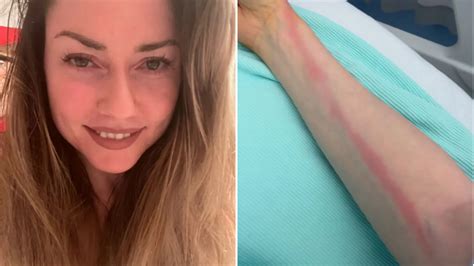 Woman Got Sepsis After Scratching Her Finger Inside A Bowling Ball
