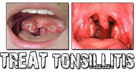 Treatment For Tonsillitis Homeopathic Cure For Tonsillitis Problem