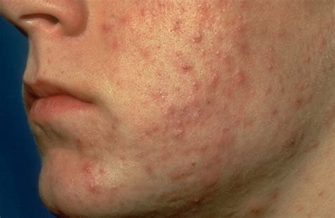 New Dermatology Guidelines Recommend Combination Treatment For Teens