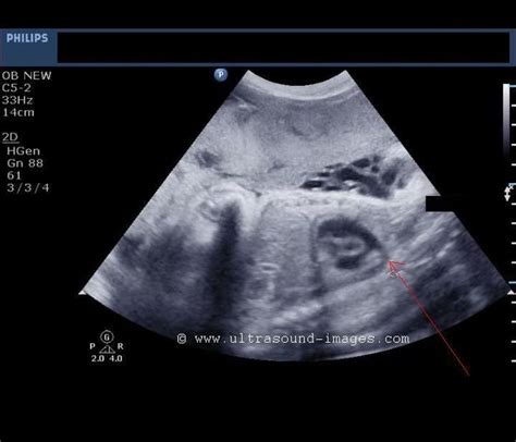 A Gallery Of High Resolution Ultrasound Color Doppler And 3d Images Fetal Chest