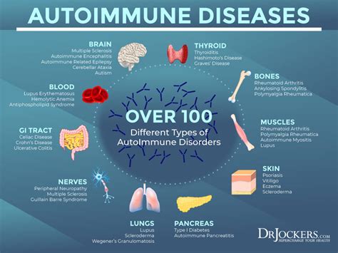 How To Cure Autoimmune Disease Trackreply4