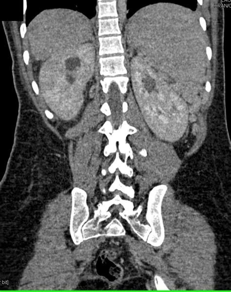 Acute Pyelonephritis In A Pregnant Patient Kidney Case Studies