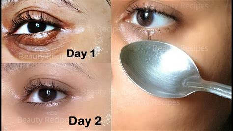 How To Remove Under Eye Wrinkles Under Eye Bags Puffy Eyes And Dark Circles In 1 Day With Ice