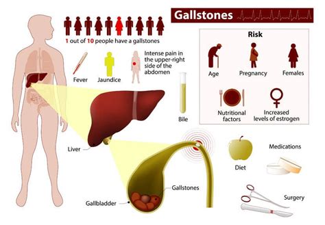 Gallstones 200 Stones Removed In Womans Stomach After She Did This