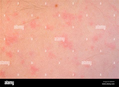 Allergic Skin Reaction Caused By An Intolerance To Penicillin Stock