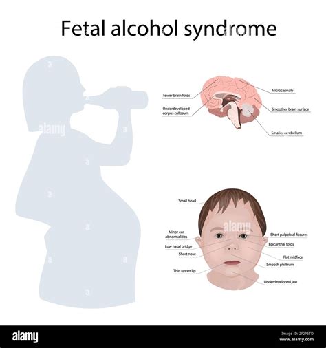 Foetal Alcohol Syndrome Hi Res Stock Photography And Images Alamy