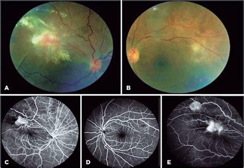 Scielo Brasil Acute Ocular Toxoplasmosis Presenting As A Retinal