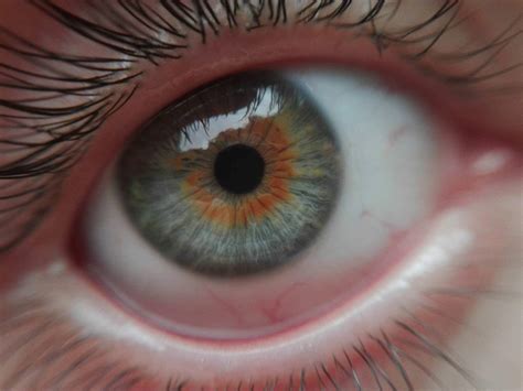 Seems Like Central Heterochromia Is Pretty Common But Ill Still Love