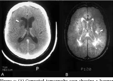 Figure 1 From Chronic Kidney Disease And Cerebral Small Vessel Disease