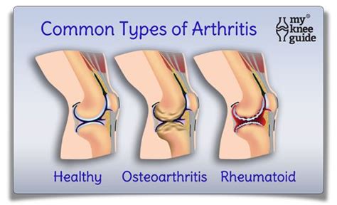 There are more than 100 different kinds of arthritis and related conditions. Arthritis: Osteoarthritis and Rheumatoid arthritis | Knee ...