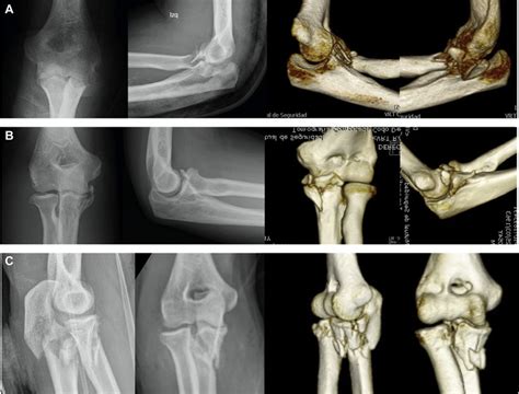 Complex Elbow Dislocations Patterns After Primary Or Spontaneous