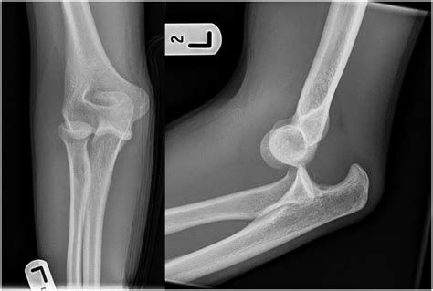 Irreducible Posterolateral Elbow Dislocation A Rare Injury Fenelon