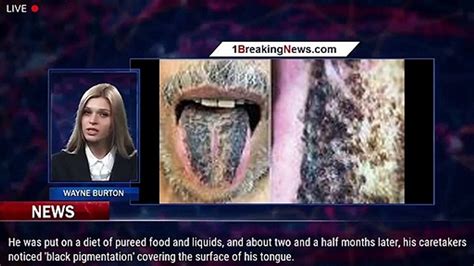 Stroke Victims Tongue Turns Black And Hairy Because Of His Pureed Diet