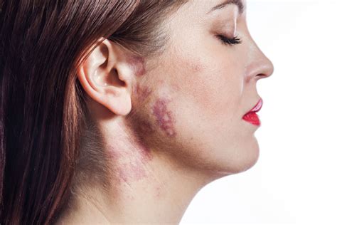 What Causes A Birthmark Nation Online