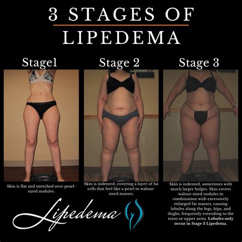 Learn About Lipedema Nodules And How To Determine If You Have Them