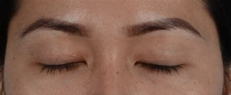 How Do Eyelid Scars Heal Before And After Photo Gallery