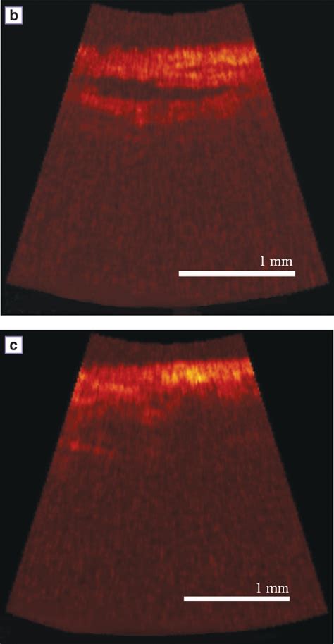 Figure From Optical Coherence Tomography As A Tool In Reproductive Gynecology Semantic Scholar