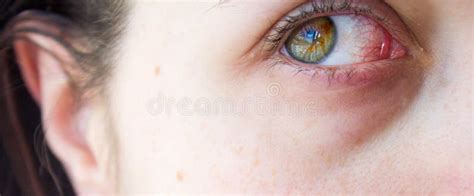 Close Photo Sick Green Eye With Blood Vessels Conjunctivitis