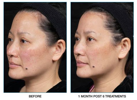 Clear Brilliant Laser Nyc Laser Treatment And Dermatology